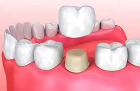 Dental Services | Crowns & Bridges Dental Services | Crowns & Bridges