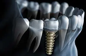 Dental Services | Dental Implants Dental Services | Dental Implants